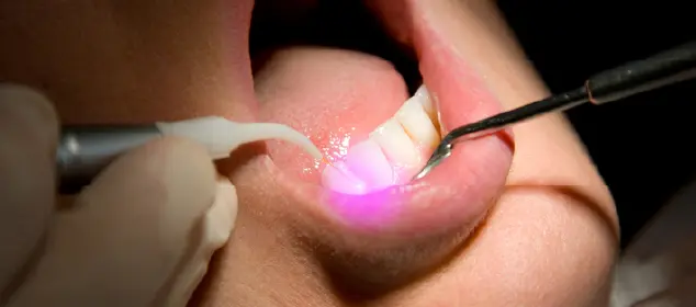 Laser Dental Treatment in Gurgaon